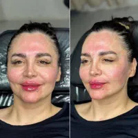 لیفت صورت با نخ. ژل.بوتاکس.مزوژل. درکلینیک|خدمات آرایشگری و زیبایی|کرمانشاه, |دیوار