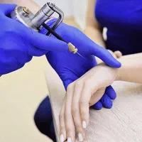 از بین بردن زگیل توسط پزشک (زگیل تناسلی)