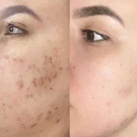 پاکسازی ،فیشیال صورت