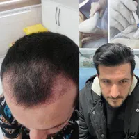 جشنواره کاشت مو|خدمات آرایشگری و زیبایی|زنجان, |دیوار