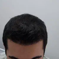 کاشت مو تخصصی ایلام