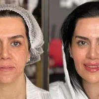 اصلاح فرم صورت.جوانسازی به روش یانگ فیس توسط متخصص|خدمات آرایشگری و زیبایی|مشهد, سناباد|دیوار