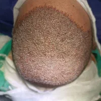 کاشت مو ، ریش و ابرو|استخدام درمانی، زیبایی، بهداشتی|شیراز, بعثت|دیوار
