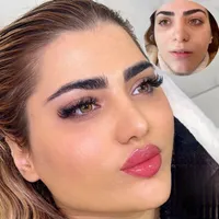 تزریق ژل وبوتاکس وفیلر ومادلینگ صورت توسط پزشک
