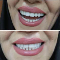دندان،دندانسازی،اقساطی،دندان مصنوعی،تخفیف