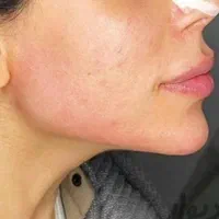 تزریق ژل و بوتاکس و فیلر زیر چشم ،نخ ،مزو ، آنزیم|خدمات آرایشگری و زیبایی|کرج, گوهردشت|دیوار