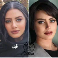 عمل بینی فقط ۲۵م باروشی جدیدبدون درد+مشاوره رایگان|خدمات آرایشگری و زیبایی|شیراز, فرهنگ شهر|دیوار