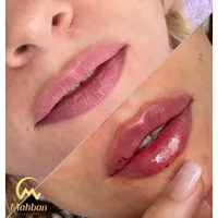 فیلرژل لب بوتاکس فیلر مادلینگ لیزرموهای زائدفشیال|خدمات آرایشگری و زیبایی|تهران, نیروی هوایی (پیروزی)|دیوار