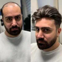 پروتز مو ، چسب پروتز ، ترمیم و تعویض چسب|خدمات آرایشگری و زیبایی|تبریز, |دیوار