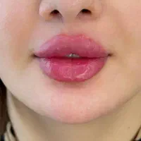 لیفت صورت نخ،ژل لب بوتاکس هایفو لیزر موتیتانیومprp|خدمات آرایشگری و زیبایی|مشهد, وکیل‌آباد|دیوار