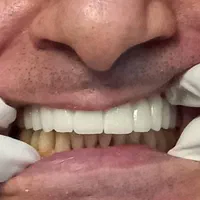 ایمپلنت اقتصادی|خدمات آرایشگری و زیبایی|تهران, فدک|دیوار