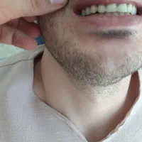 دندان مصنوعی متحرک (تحویل ۳ روزه)|خدمات آرایشگری و زیبایی|کرمانشاه, |دیوار