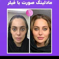 تزریق ژل لب بوتاکس هایفولیزرفیلرلیفت صورت سفیدسازی|خدمات آرایشگری و زیبایی|تهران, صادقیه|دیوار