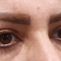 (شوش، شوشتر، اندیمشک) بلفاروپلاستی|خدمات آرایشگری و زیبایی|شوش, |دیوار