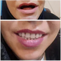 دندانسازی /دندان متحرک /دندان مصنوعی|خدمات آرایشگری و زیبایی|مشهد, حرم مطهر رضوی|دیوار