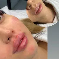 تزریق ژل.بوتاکس.انزیم.چال لپ‌.مزوپیرسینگ|خدمات آرایشگری و زیبایی|فردیس, فردیس|دیوار