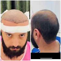کاشت مو سوزن ۰/۷،کاشت ابرو کره ای(تیم شیراز در یزد