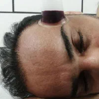 حجامت و زالودرمانی را در منزل خودتان تجربه کنید .|خدمات آرایشگری و زیبایی|اهواز, زیباشهر|دیوار