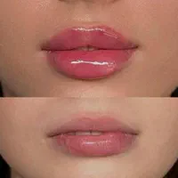 ژل لب چانه گونه بوتاکس فیلرآنزیم بینی لیزرهایفو|خدمات آرایشگری و زیبایی|مشهد, سجاد شهر|دیوار