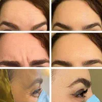 بوتاکس صورت و زیر بغل(جشنواره)در مطب|خدمات آرایشگری و زیبایی|اصفهان, ملک‌شهر|دیوار
