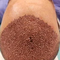 کاشت موی طبیعی به روش fit ،و سوپر sut|خدمات آرایشگری و زیبایی|اهواز, کیانپارس |دیوار