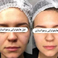 هایفوتراپی جوانسازی لیفت صورت غبغب آف به مدت محدود|خدمات آرایشگری و زیبایی|قم, شهرک قدس|دیوار