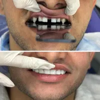 روکش دندان زیرکونیا مناسب|خدمات آرایشگری و زیبایی|تهران, افسریه|دیوار