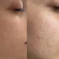 کربوکسی تراپی همراه با فیشال دوتا باهم ۳۵۰