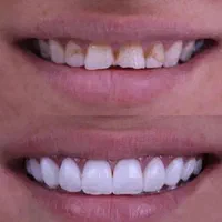 کلینیک تخصصی روکش و روکش ایمپلنت با تضمین کیفیت|خدمات آرایشگری و زیبایی|تبریز, |دیوار