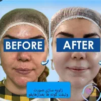 هایفوتراپی،لیفت وجوانسازی صورت،رفع غبغب