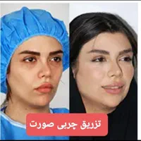 تزریق چربی صورت،ژل،بوتاکس،لیزر،لاغری
