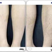 لیزر موهای زائد لیزر آقایان لیزر بانوان لیزر خانم|خدمات آرایشگری و زیبایی|اصفهان, سعادت‌آباد|دیوار