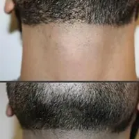 لیزر دائمی خط ریش وپشت گردن وموهای زائدگوش۱۹۰تومن|خدمات آرایشگری و زیبایی|قم, حنیف نژاد|دیوار