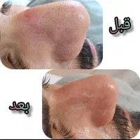 پاکسازی و فیشیال پوست|خدمات آرایشگری و زیبایی|یاسوج, |دیوار