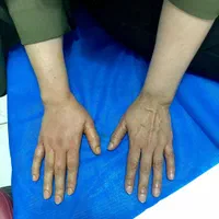 پیوند چربی بدن