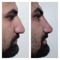 اصلاح قوز و افتادگی بینی بدون جراحی در مطب20%تخفیف|خدمات آرایشگری و زیبایی|شاهین‌شهر, فردوسی|دیوار