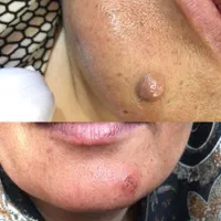 درمان گوشت اضافه  بر اثر سوختگی وچاقو، غیره|خدمات آرایشگری و زیبایی|کوهدشت, |دیوار