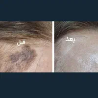 برداشتن انواع خال لک زیگیل تناسلی و...|خدمات آرایشگری و زیبایی|اصفهان, شهرک کوثر|دیوار