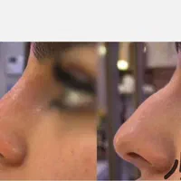 آموزش کوچک کردن بینی فیلرژل و بوتاکس آنزیم|خدمات آرایشگری و زیبایی|مشهد, آزادشهر|دیوار
