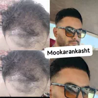 کاشت مو تراکم بالا (بدون تراشیدن سر)|خدمات آرایشگری و زیبایی|محمدشهر, |دیوار