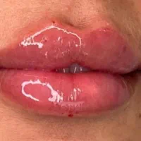 فیلر و بوتاکس با متد جدید|خدمات آرایشگری و زیبایی|رشت, گلسار|دیوار