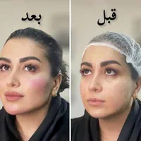 تزریق ژل و بوتاکس تخفیف بهاره ۳۹۹|خدمات آرایشگری و زیبایی|تهران, نازی‌آباد|دیوار