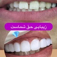 کامپوزیت دندان|خدمات آرایشگری و زیبایی|سبزوار, کاشفی شمالی (دادگستری)|دیوار