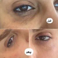 اف تزریق ژل و بوتاکس توسط کادر درمان در کلینیک|خدمات آرایشگری و زیبایی|اهواز, پادادشهر|دیوار