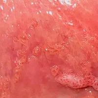 درمان زگیل،تبخال تناسلی خانمهاو آقایان،درمطب متخصص|خدمات آرایشگری و زیبایی|تبریز, |دیوار