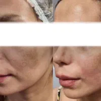 جشنواره هایفو جوانسازی لیفت پوست صورت|خدمات آرایشگری و زیبایی|تهران, صادقیه|دیوار