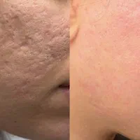 درمان مشکلات پوست مطب/مزوتراپی/فشیال/مزونیدلینگ/ژل|خدمات آرایشگری و زیبایی|مشهد, دانشجو|دیوار