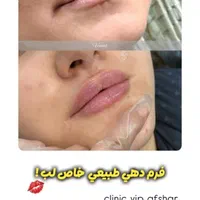 تزریق ژل و بوتاکس و فیشال تخصصی توسط پزشک|خدمات آرایشگری و زیبایی|برازجان, |دیوار