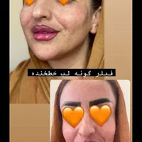 تزریق، فیلر ، بوتاکس، ژل ، آنزیم|خدمات آرایشگری و زیبایی|شیراز, سینما سعدی|دیوار