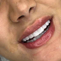 کامپوزیت دندان /لمینت / عصب کشی / زیبایی|خدمات آرایشگری و زیبایی|تهران, تهرانپارس غربی|دیوار